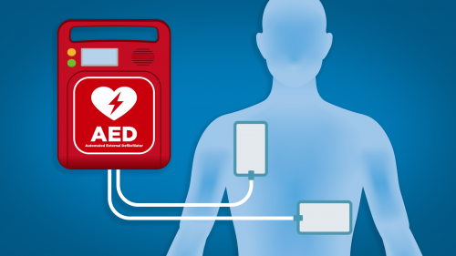 Cómo usar desfibrilador externo automático